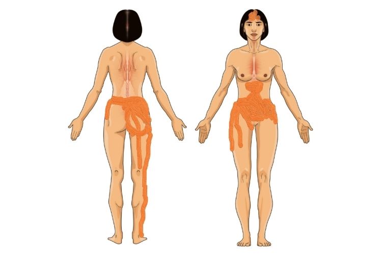 Endometriosis pain map