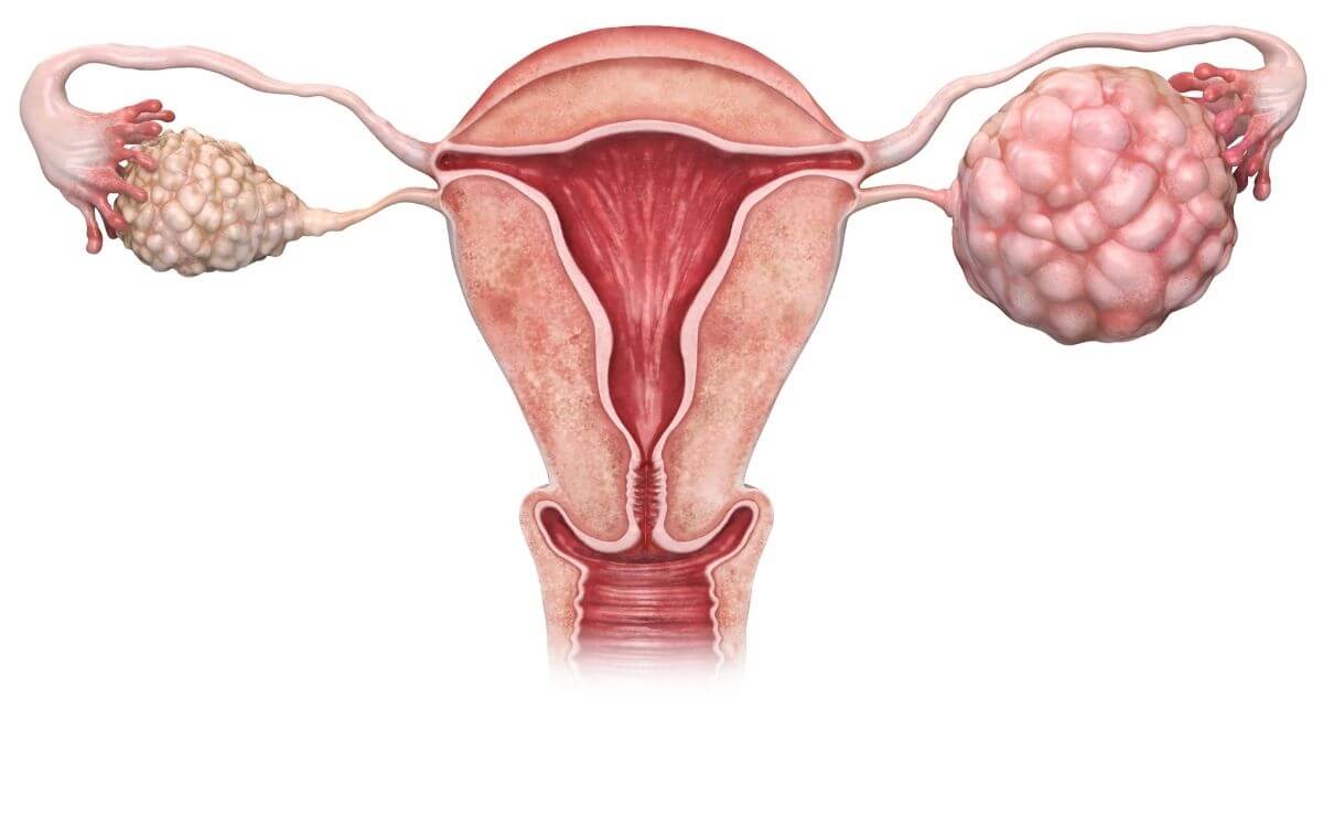 Endometriosis blog page