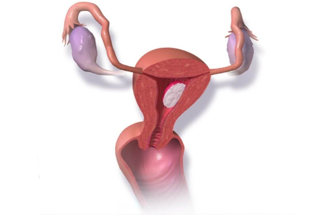 What is deep infiltrating pelvic endometriosis 1