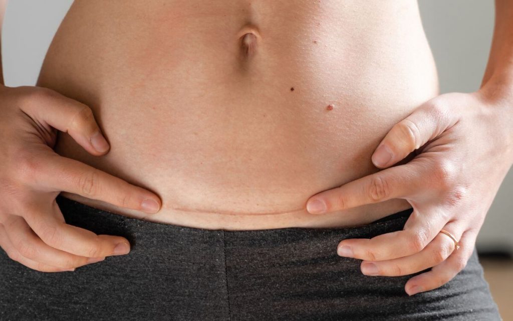 Pictures of stomach after hysterectomy 1