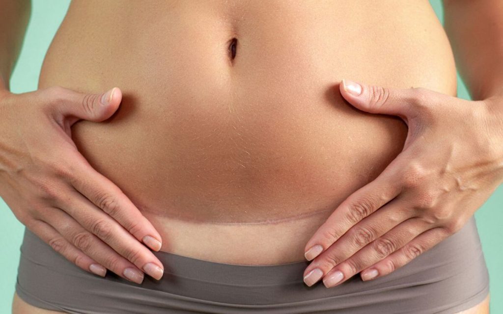 Pictures of stomach after hysterectomy 2