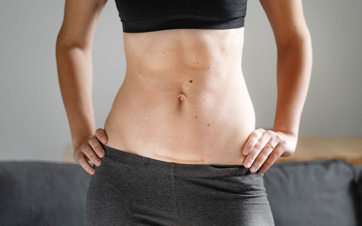 Pictures of stomach after hysterectomy.